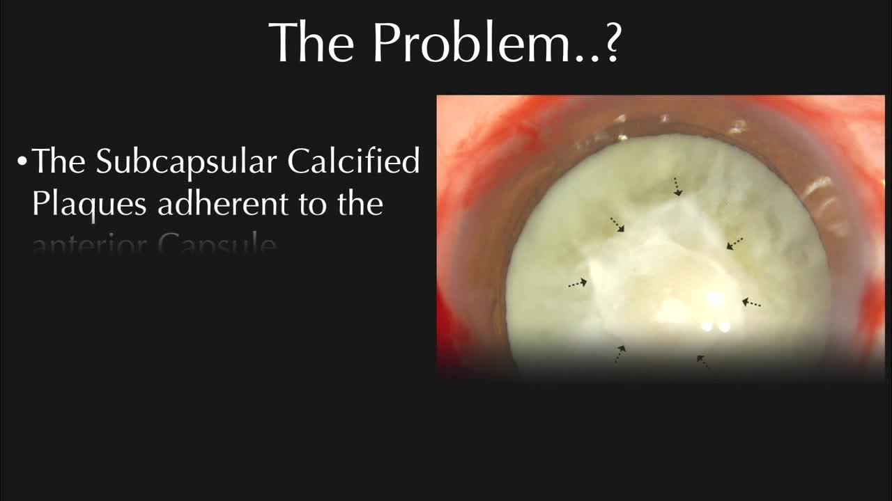 Calcified and Fibrotic Plaques