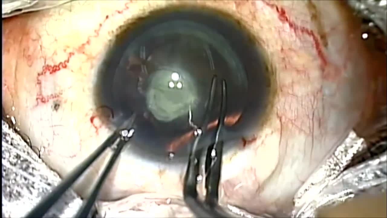Posterior Polar