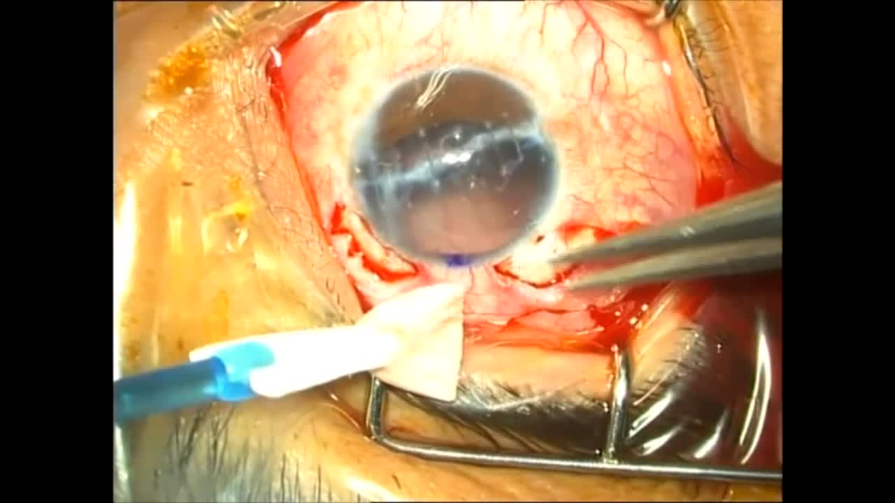 Traumatic Aphakia / Iris Loss