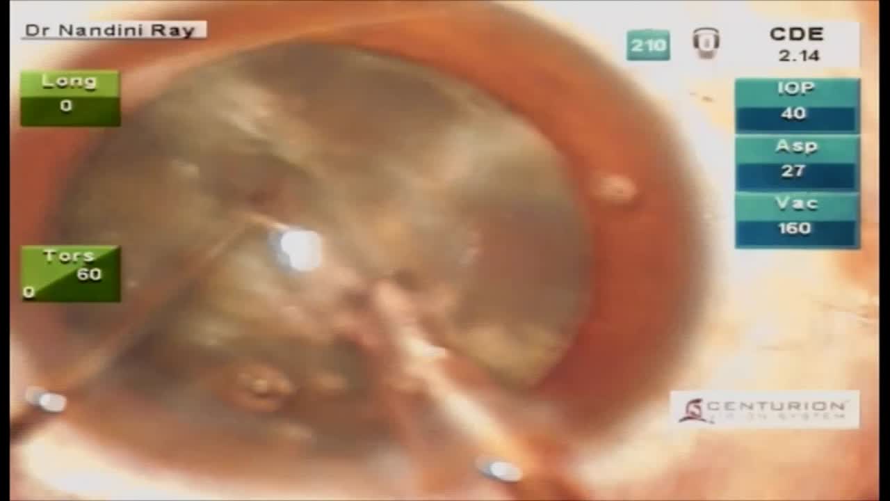 Sculpting Through the Capsule