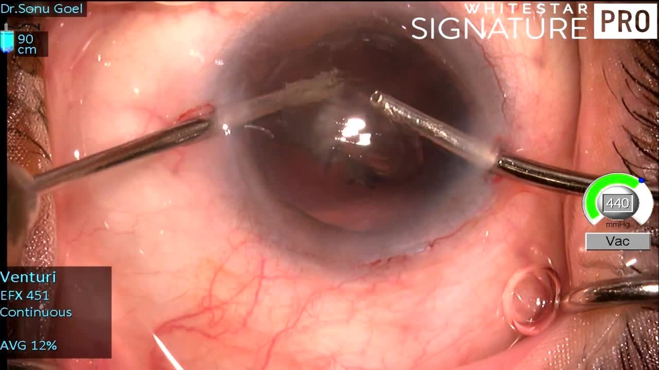 Cannula Missile