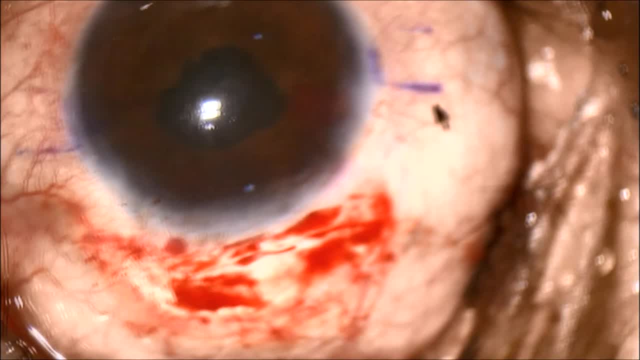 Opaque IOL