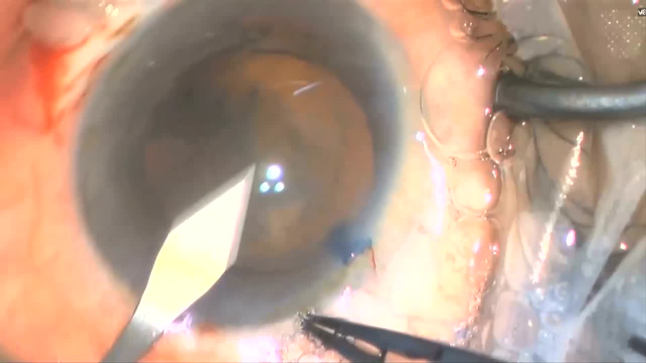 Phacoemulsification in Corneal Opacities: A Novel Approach to Restore Sight to the Surgeon