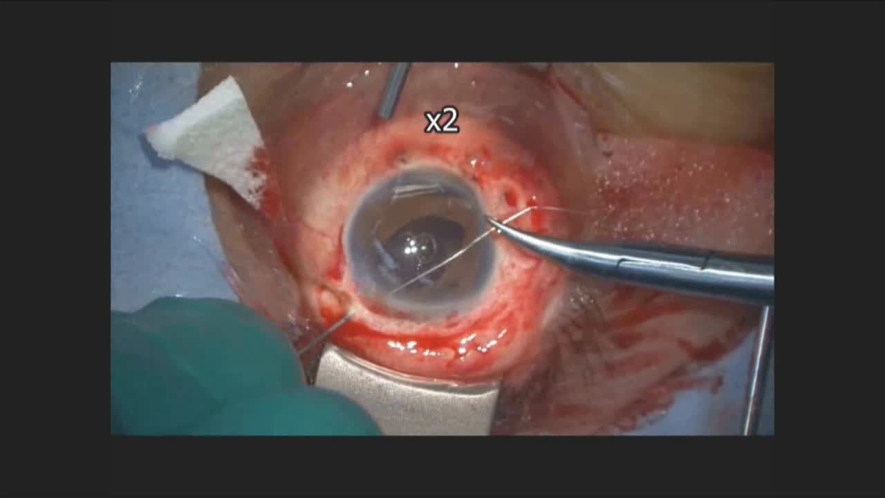 Repair of Iris Dialysis by Riveting with Doubled-Flanged Polypropylene Sutures