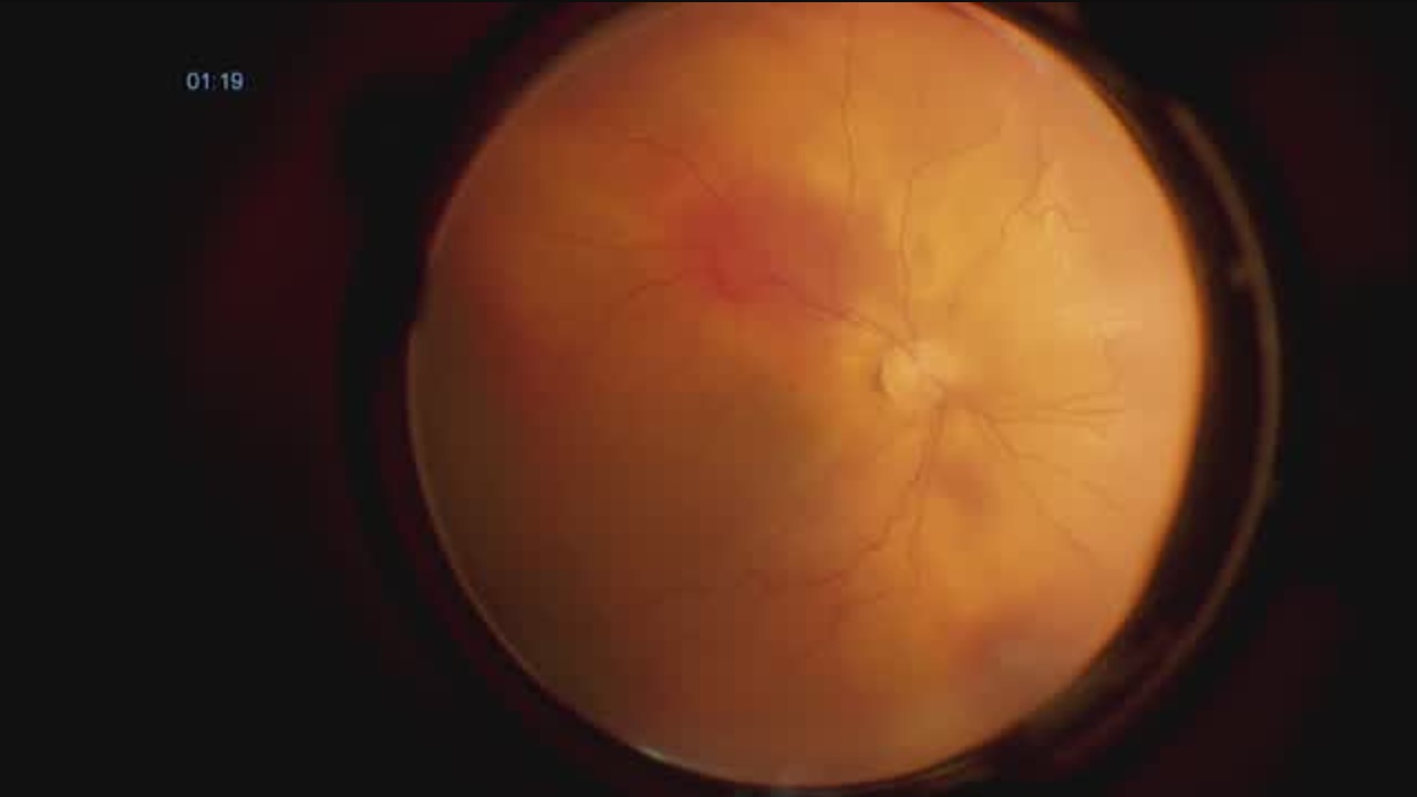 Misinterpreted Preoperative Ultrasound Contributes To Complicated Surgery [FLOREtina Live Surgery]
