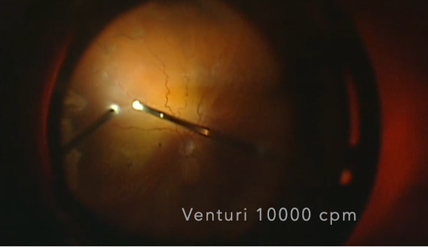Three Pump Systems During Vitrectomy