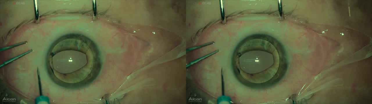 Giant Retinal Tear Trauma (3D)