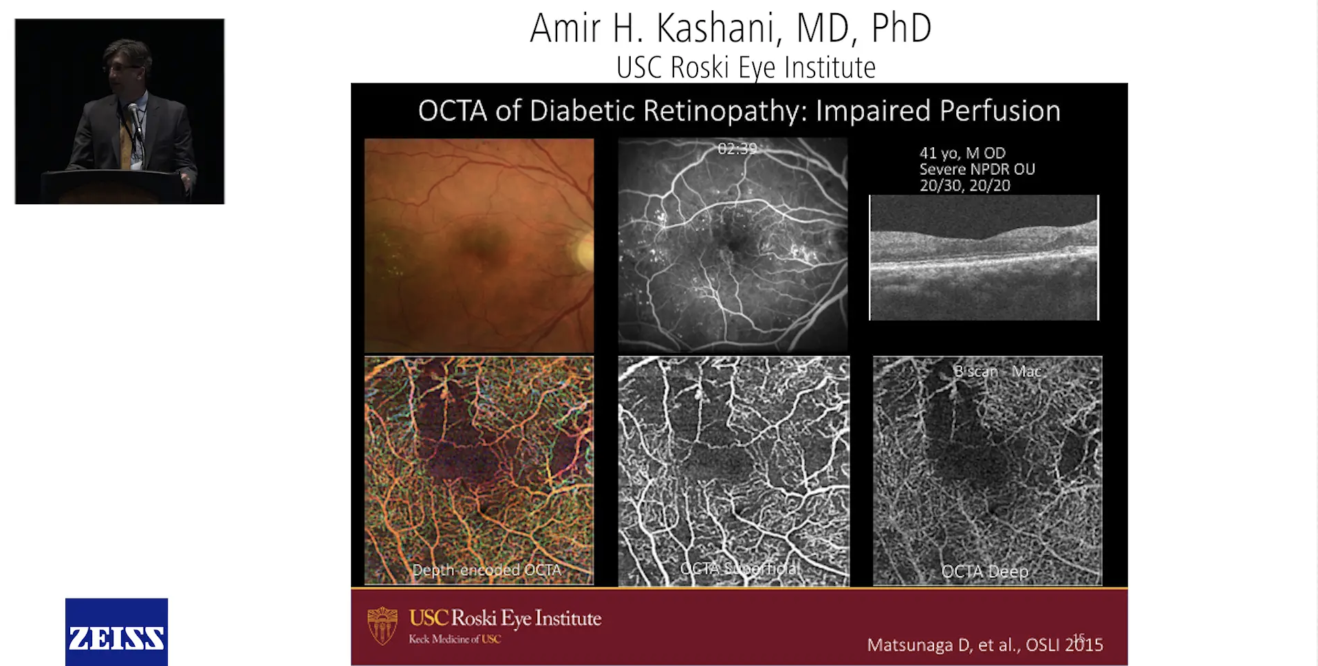 Practical Considerations for OCTA