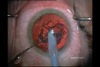 Bowl and Snail Technique for Soft Cataract