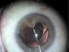 Cataract Extraction in Chronic Angle Closure with Goniosynechialysis