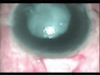 Thorn Prick Traumatic Ruptured Lens