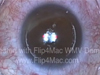 Infinite Possibility: Using Small Aperture Corneal Inlay to Treat Variety of Presbyopic Patients