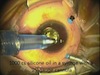 Injection of 1000 Centistokes Silicone Oil using 25G Vitrectomy Technique