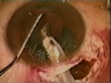 Iris Damage