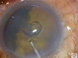 Suspension Bridge Incision