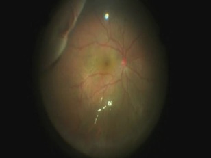 Suprachoroidal Buckling With a 25-gauge Illuminated Suprachoroidal Catheter