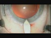 Incision with Internal Flare