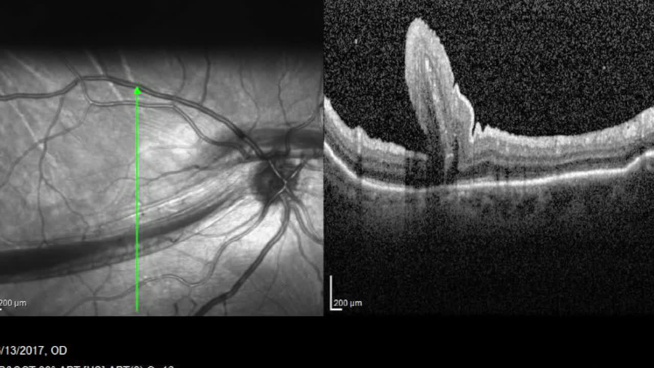 Macular Retinal Fold Repair