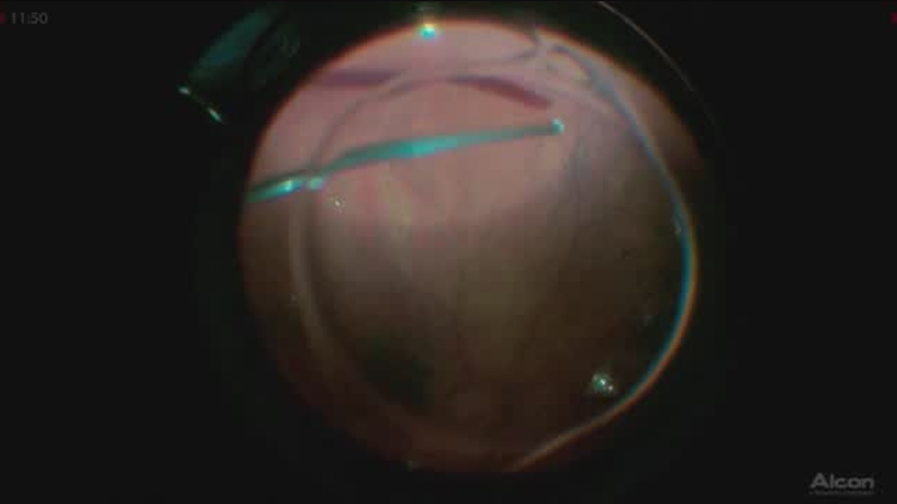 Surgery for VMT with ERM [FLOREtina Live Surgery]