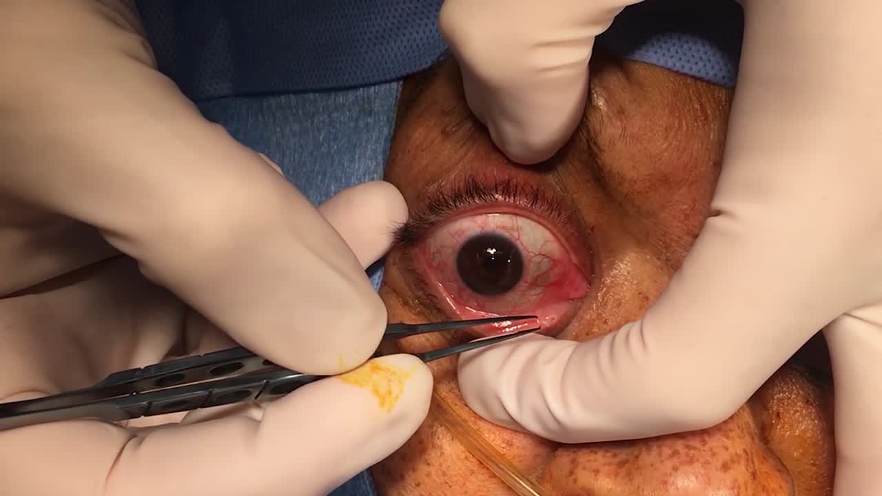 Nasolacrimal Duct Intubation With Mini-monocanalicular Stent