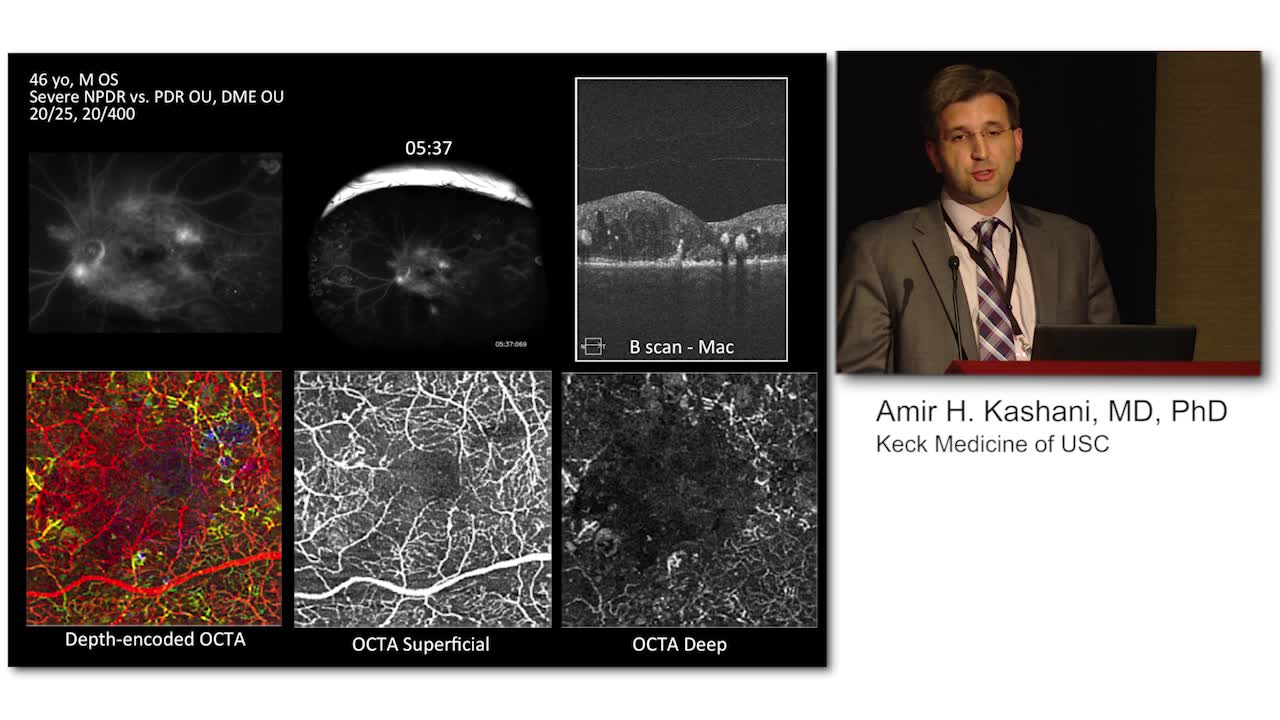 The Value of OCT-A in Management of Diabetic Retinopathy