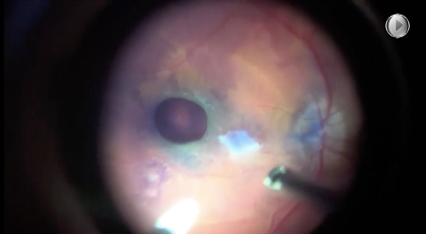 Traumatic Macular Hole