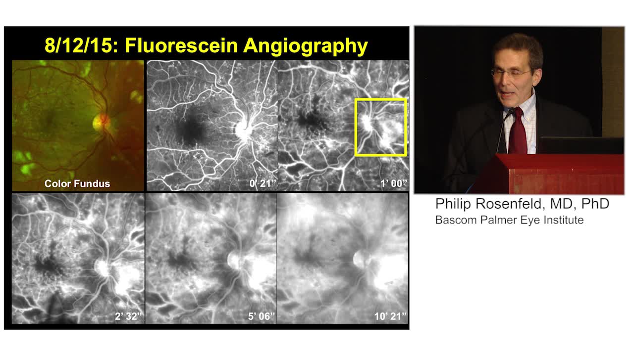 Case Report of Retina Vascularization in Diabetic Retinopathy: Implications of OCT-A Findings for Patient Management