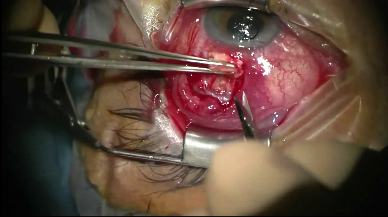 Post-Op Management of IOP Elevation Following Uneventful Valved Tube Shunt Implantation