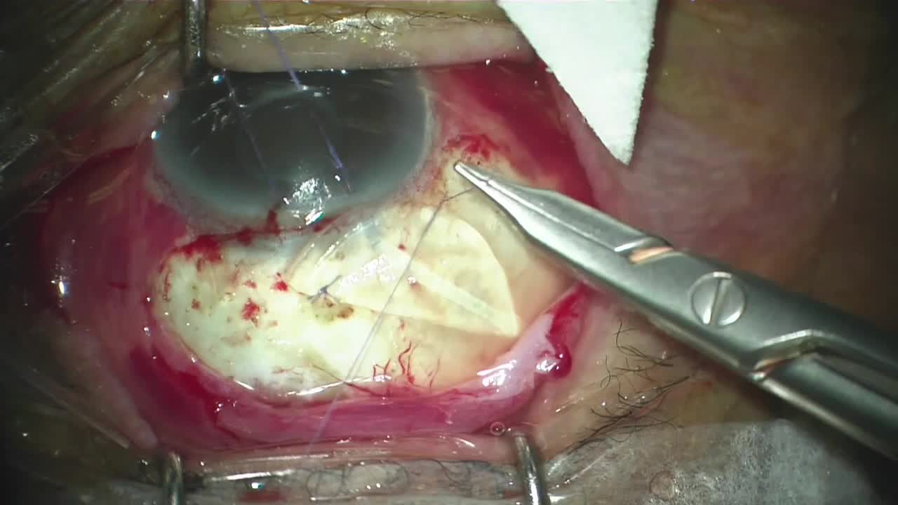Ahmed Glaucoma Valve (Model FP7) Surgical Instructions