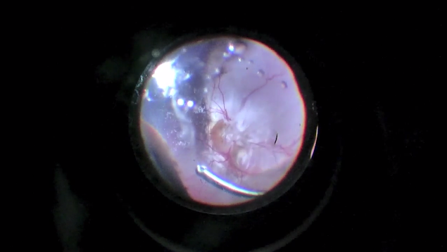 Pediatric Total Retinal Detachment With Coloboma of the Choroid and Optic Nerve