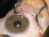 Cataract Surgery in a Patient with Diabetes