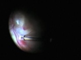 Surgical Arterial Embolectomy