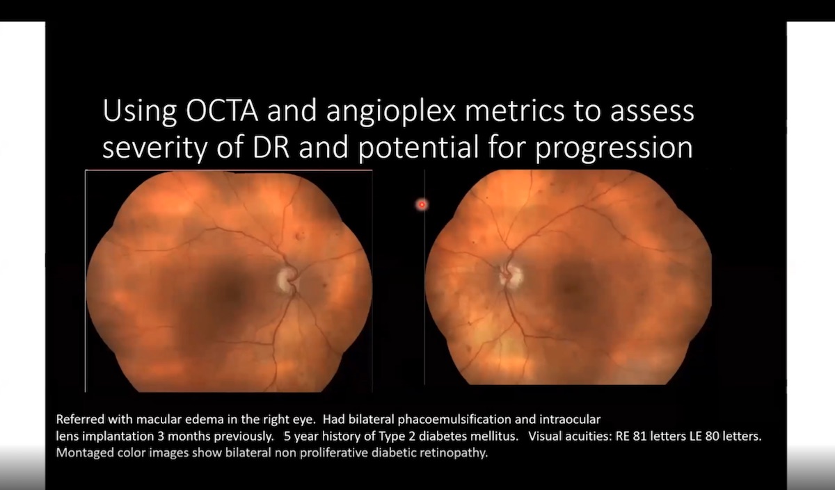 OCT-A Interpretation: A Case Based Analysis of Vascular Disease