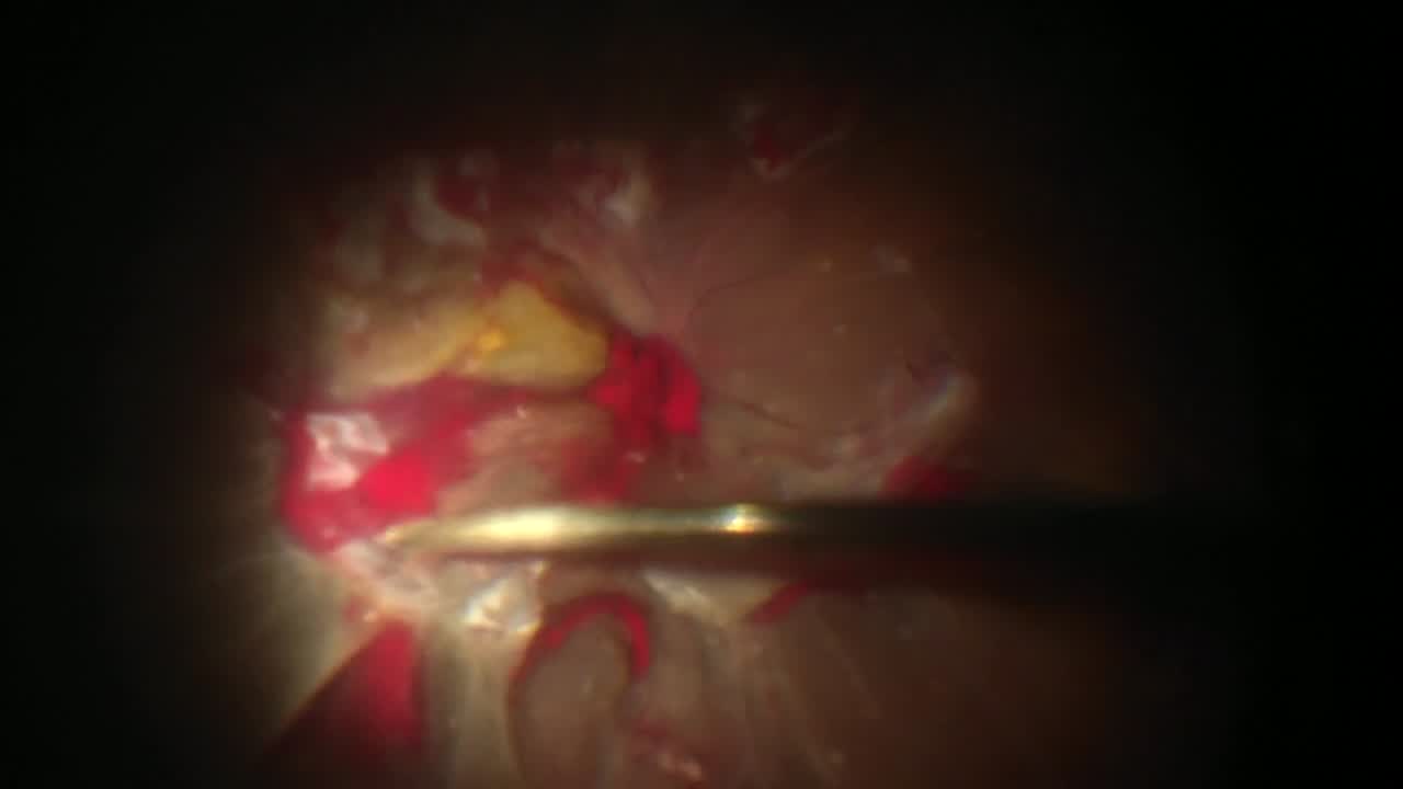 Diabetic TRD
