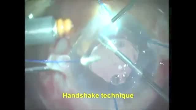 Triumvirate Technique: Modified PAL with IOL Scaffold and Glued IOL