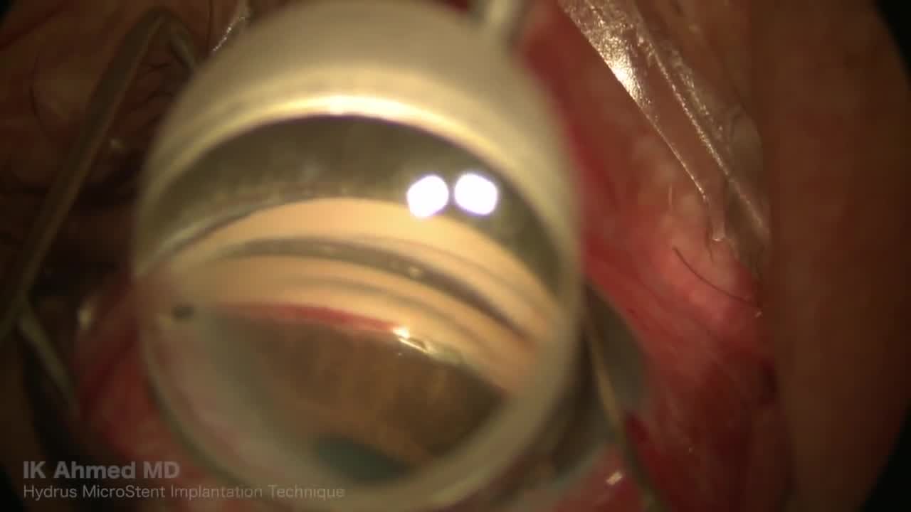 Hydrus Microstent for Glaucoma