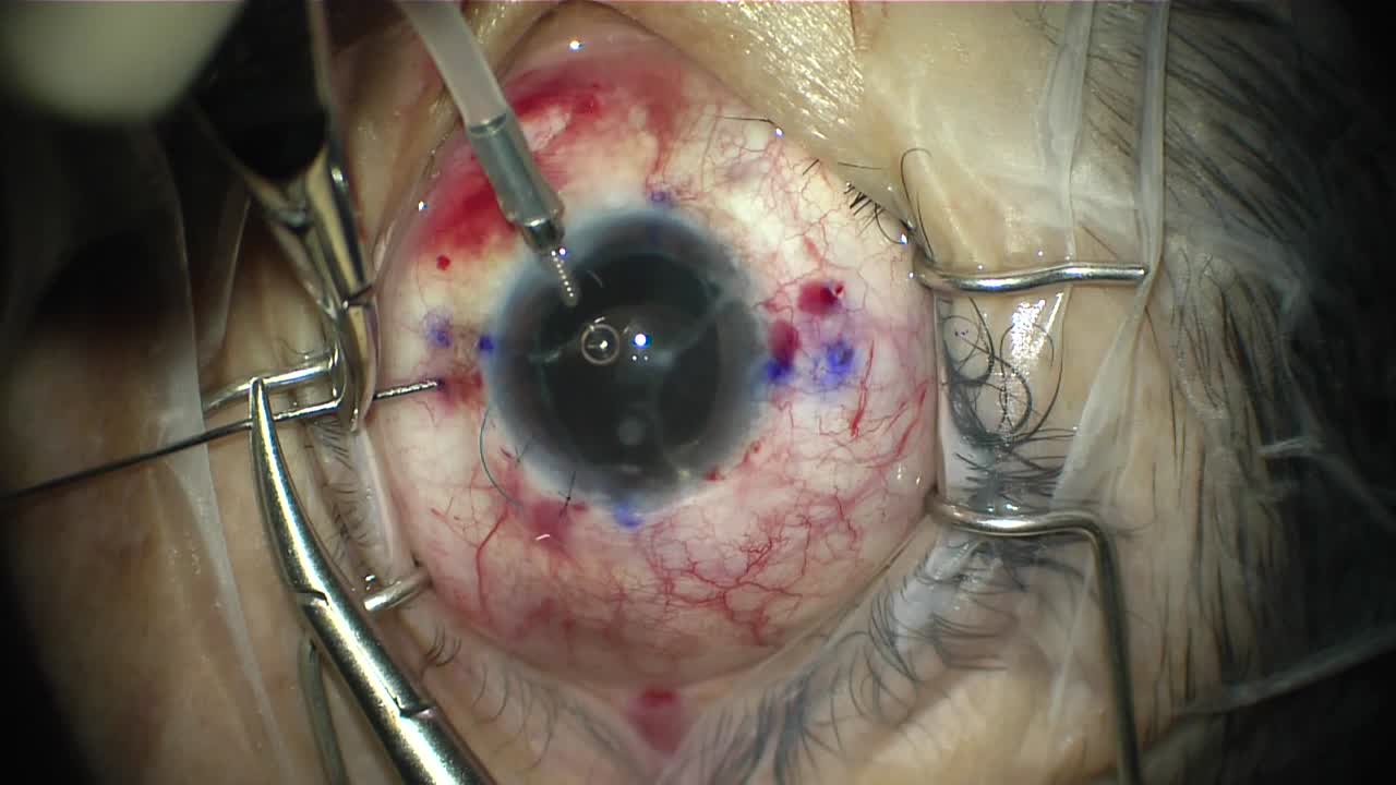 Modified Yamane Technique: Resident Case