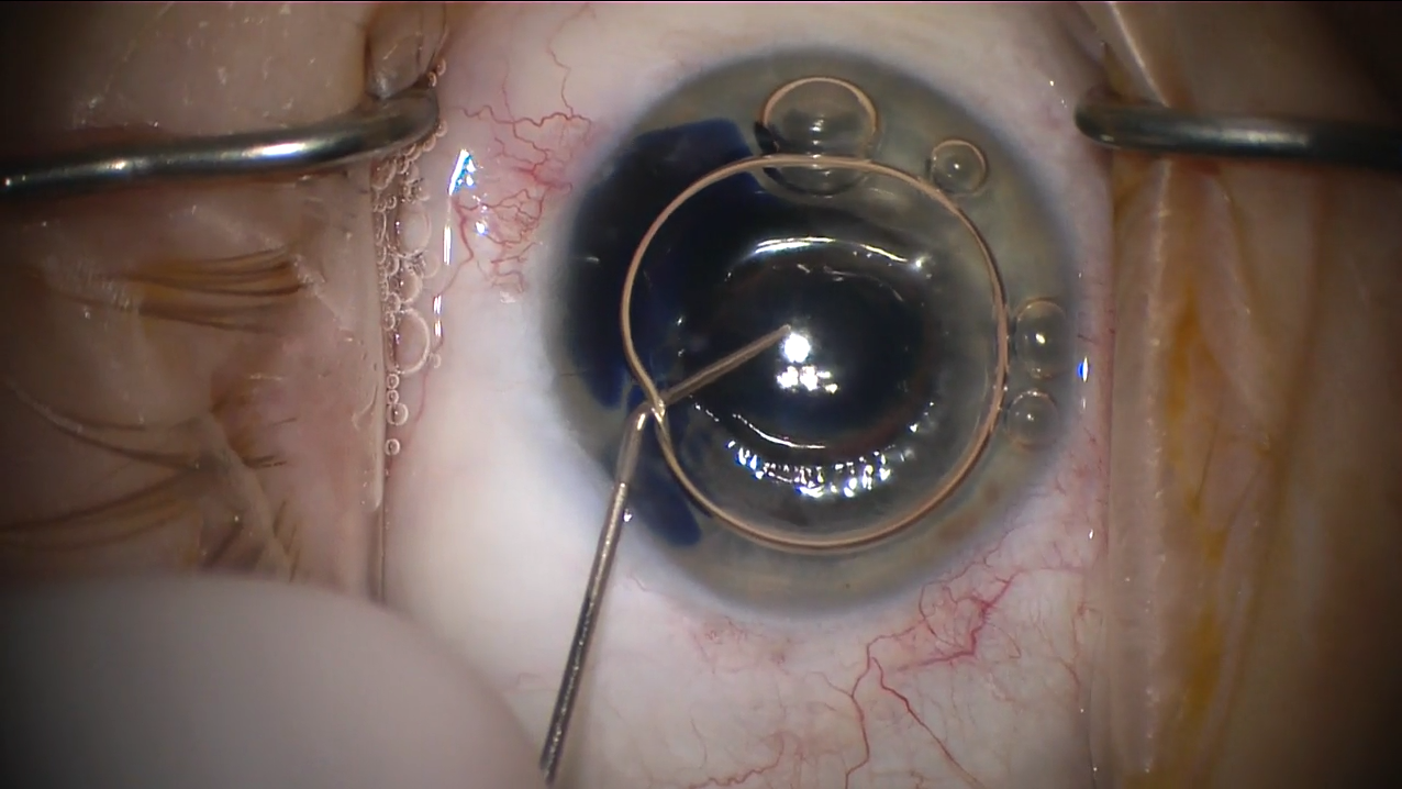 IOFB Glaucoma and Cataract