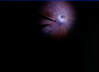 Optic Nerve Pit