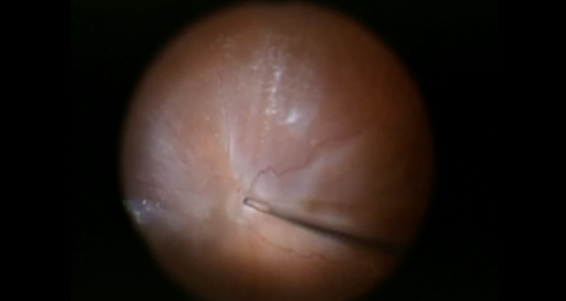 Posterior PVR: ERM/ILM Peel During a Retinal Detachment