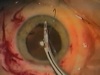 The Low Low Myope - Part 1