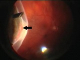 Vitreous Management in Cataract Surgery