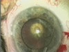 Posterior Polar Cataract - Part 2