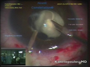 Anterior Vitrectomy with Sulcus Fixated PC IOL in Pediatric Aphakia