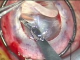 Direct Visualization of Interface during Lamellar Corneal Surgery with Slit Illumination