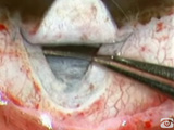 Canaloplasty: A Piece of Cake?