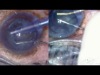 Ultra-Thin Phaco with Any Incision Size