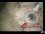 Mysterious Complication in Retina Surgery