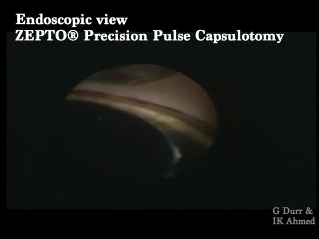 Endoscopic View of the Zepto Precision Pulse Capsulotomy