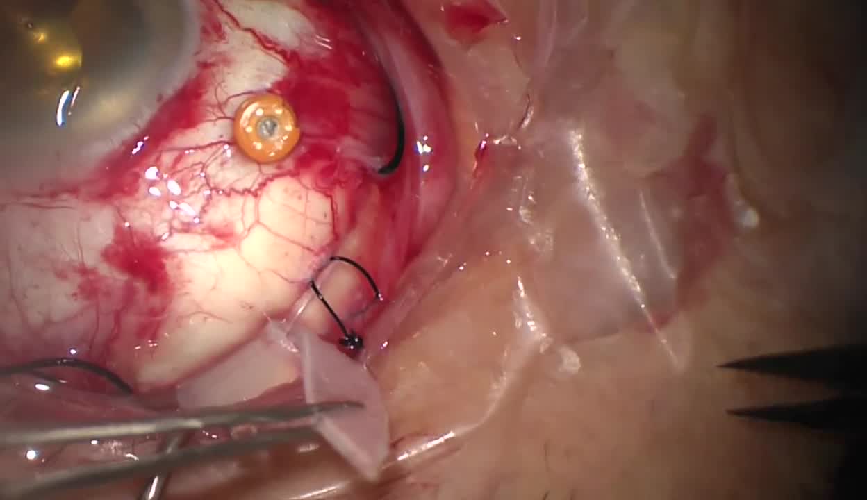 Combined Scleral Buckle With Pars Plana Vitrectomy for Rhegmatogenous Retinal Detachment with Retinoschisis